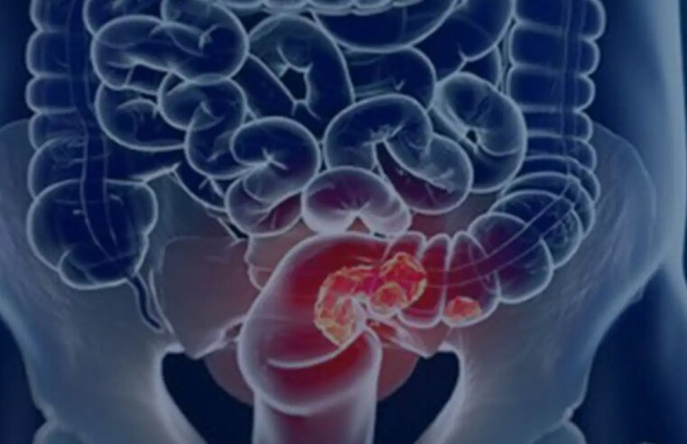 Pacientes com câncer colorretal são diagnosticados em estágio avançado