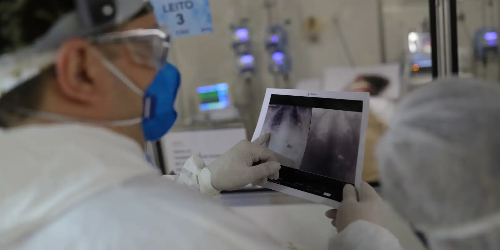 Broncopneumonia: entenda quadro que causou internação de Bolsonaro